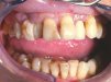 Použití flapless metody v dentální implantologii při náhradě ztráty jednoho zubu